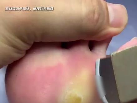 脚底长又黄又厚的硬疙瘩,不是鸡眼,千万别乱刮!#医学科普 #老茧 #鸡眼 #胼胝 #皮肤