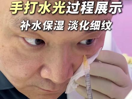 手打水光针疼不疼? #水光针 #医美 #变美