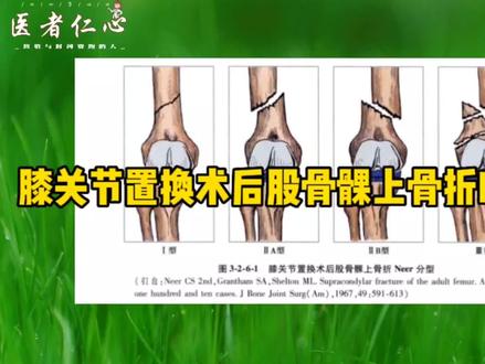 膝关节置换术后股骨髁上骨折Neer分型#膝关节置换 #膝关节置换术后骨折 #膝关节置换术后骨折分型