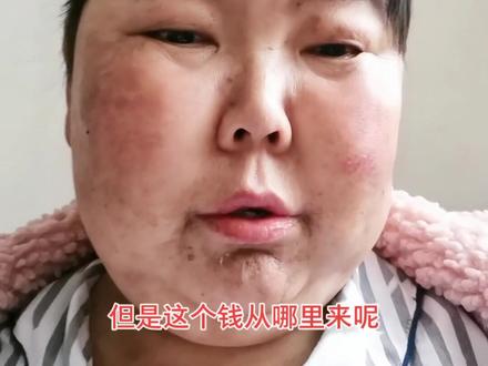 又一次面对生命的抉择,老公的支持给了我信心,准备移植#肺移植 #艰难的选择 #坚强的小白