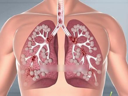 左右肺都有结节,记好红枣的王牌搭配,人人都喝得起。 #中医#健康#科普#结节#抖出健康知识宝藏