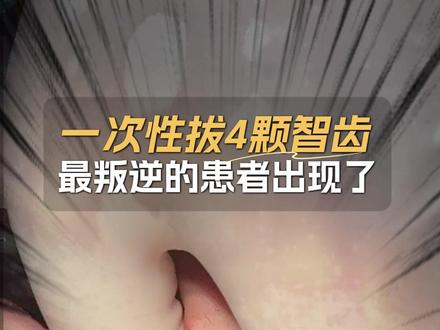 一次性拔四颗智齿,最叛逆的患者出现了 #王佃灿 #智齿一定要拔吗 #四颗智齿一起拔