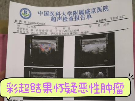 甲癌,不幸中的万幸。
单位体检后大夫叮嘱需要去门诊复查,由于自我感觉没有任何异样,并没有在意,过了大半年检查,#告知甲状腺癌,而且有淋巴转移。知道病情就感觉是晴天霹雳,头一次“癌”这个字离我如此之近。从此开始了问诊之路和无休止的查询。还好通过了解知道这个癌并没有想象中的可怕,切掉就OK啦,并不会影响寿命。随后就是去医院做术前的各项检查,一个月后接到通知安排手术。
手术当日17时30分推入手术室,21时10分清醒出来,看见家人们都在手术室门前等待,关心我的状态,感觉良好的我特意给他们比了个✌的手势让大家放心。因为术后不需要输液,积液排除即可,术后第四天拔掉引流管便通知出院。
短短的一个月好像经历了一次重生,最懒的癌症也是在警告我,从今以后,更爱自己,保持心情愉悦,规律生活,感受生活中的美好,不要熬夜!
最后希望所有人都能百病退散!