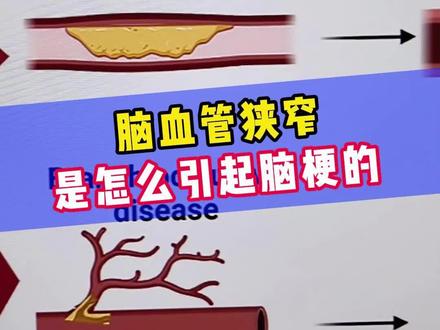 脑梗 脑血管狭窄是怎么引起脑梗的?#脑血管狭窄 #脑梗 #医学科普