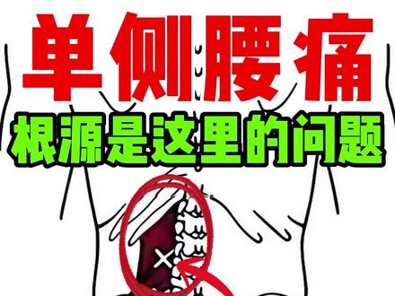 你是不是总是单侧腰痛! 其实根源在这里... 你是不是经常单侧腰酸痛
尤其是在侧身扭转时、或者久坐后起身后,感觉侧腰又酸又痛,需要缓一缓才能站直
用手摸这侧的肌肉感觉特别僵硬
那你大概率是腰方肌损伤没跑了
这块方形的肌肉就是我们的腰方肌,
它上连着肋骨 下连着骨盆,侧连着腰椎
主要作用是稳定我们腰椎和骨盆,协助完成腰部的弯曲和旋转等动作
它出现损伤通常是因为腰方肌两侧受力不均导致的
比如我们长期跷二郎腿、单肩背包、单手娃,
都会导致骨盆向一侧牵拉倾斜,使得单侧腰方肌被动拉长,
肌肉每天处于这种紧张的状态得不到放松,
时间一久,肌肉内部的纤维组织就会出现撕裂损伤,而产生疼痛
所以想要解决单侧腰方肌劳损,就要让两侧腰方肌受力均匀
不让劳损的腰方肌继续被牵拉,让它得到充分的休息
#腰肌劳损 #腰痛 #腰痛改善 #腰方肌 #腰痛怎么办