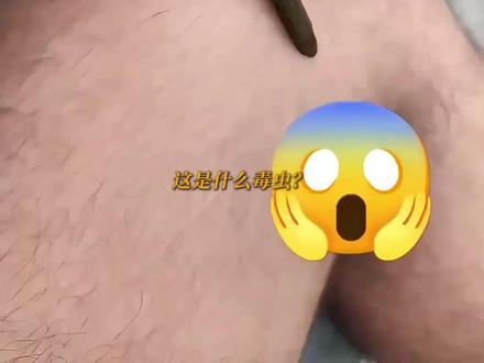 这几种毒虫你见过几种呢? #昆虫 #科普 #有害昆虫