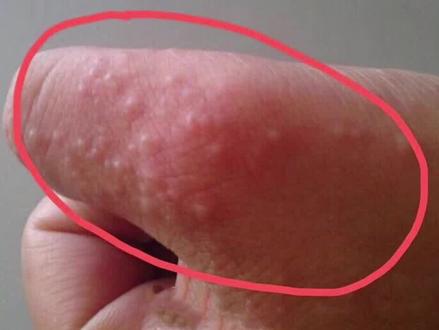手上有小水泡很痒,是怎么回事? #汗疱疹 #皮肤 #医学科普