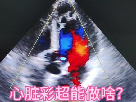 心脏彩超能做啥?
做心脏彩超的时候,有人问我心脏彩超都能查啥呀?现在我告诉大家
心脏彩超是一种无创、安全的影像学检查,通过超声波动态观察心脏的结构和功能。以下是它能检查的主要项目:
1、心腔大小:检测心房、心室是否扩大或缩小(如心肌病、高血压性心脏病)。
2、室壁厚度:评估心肌肥厚
(如肥厚型心肌病),心肌变
薄(如心肌梗死后的室壁瘤)。
3、瓣膜形态:观察二尖瓣、主动脉瓣等是否有狭窄、关闭不全、钙化或畸形(如风湿性心脏病、老年退行性变)。
4、先天性异常:诊断房间隔缺损、室间隔缺损、法洛四联症等先天性心脏病。
5、心脏功能评估
·收缩功能:测量左心室射血
分数(EF),判断心脏泵血能力(如心衰时EF值降低)。
·舒张功能:评估心脏舒张期充盈是否受限(常见于高血压、心肌肥厚)。
6、室壁运动:检测心肌缺
血或梗死导致的局部运动异常。
7、血流动力学检查
·血流速度与方向:通过多普
勒技术观察血流是否异常
(如瓣膜反流、狭窄处的湍流)。
8、压力评估:间接估算肺动脉压力(诊断肺动脉高压)。
9、心包疾病:检测心包积液、心包填塞、心包增厚(如心包炎)。
10、心脏占位性病变:发现心脏肿瘤、血栓(常见于房颤患者)。
11、人工瓣膜功能:评估术后人工瓣膜的工作状态。
12、常见适用症状或疾病
·胸闷、气短、心悸、心脏杂音需明确原因。
13、冠心病、心肌病、瓣膜病、心包疾病的诊断与随访。术前评估及术后复查。总之心脏彩超可查数十种心脏病哦。
心脏彩超检查的优势与局限
·优势:无辐射、可重复、实
时动态成像。
·局限:肺气肿患者或肥胖者成像可能受限,此时需要结合心脏 MRI或CT。
#心脏 #心脏病#心脏彩超报告#心肌梗塞 #医学科普