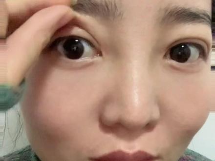 埋线好在不喜欢还有退路😄#双眼皮恢复记录 #埋线提升 #变美那些事