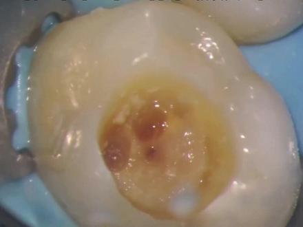 太酸爽了!#牙医实拍发现虫牙全过程 你的牙齿上有小黑点吗?