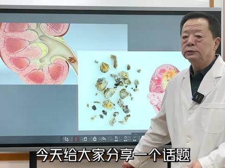 肾结石有哪些并发症?对人影响严重吗? #抖医医生 #医学常识 #胆结石 #结石