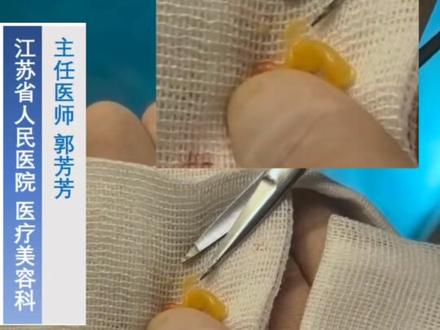 腋窝里长了小豆豆,怎么办?#皮肤肿物 #微创手术