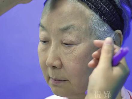 又刷新纪录了,74岁西安来的教授阿姨,来拉皮❗️#上热门🔥上热门 #拉皮手术恢复期 #拉皮手术 #苹果肌复位 #拉皮失败修复