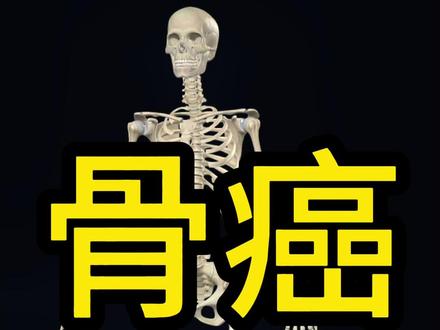骨癌(骨肿瘤),到底是什么? #骨癌 #骨肿瘤