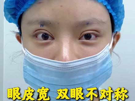 双眼皮修复出镜人已签署相关肖像授权,此视频不宣导任何风险医疗项目!如有不适,请线下就医。出镜人已满25周岁!#双眼皮修复#双眼皮 #双眼皮马娟 #双眼皮修复马娟 #马娟