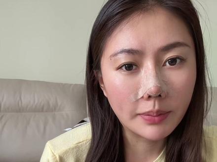 隆鼻后为什么会产生排异?