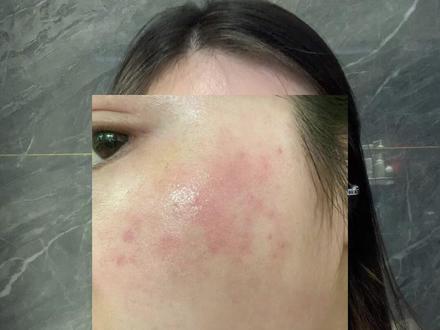 皮肤屏障受损应该怎么办