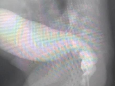 新生儿先天性巨结肠由于病史比较短,狭窄段、扩张段往往形态还不完全固定,所以钡剂灌肠检查存在典型巨结肠形态的概率会比婴幼儿低。但如果狭窄段痉挛比较严重的情况下,容易出现典型的巨结肠的形态。#巨结肠宝宝#巨结肠#腹胀#便秘#钡剂灌肠