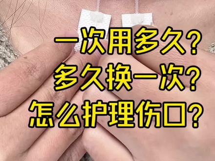 减张器怎么用?#甲状腺术后 #甲状腺术后疤痕 #减张器怎么用