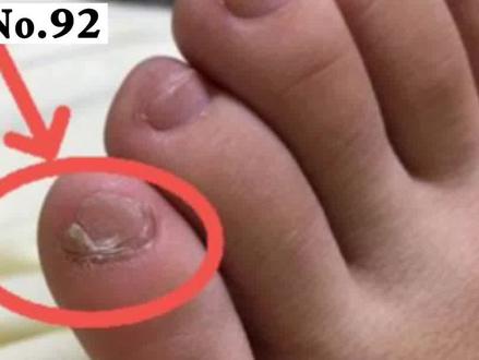 你的小脚趾趾甲是不是也是一大一小两瓣#瓣状甲 很常见,你知道是上面原因吗?#涨知识 #趾甲