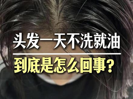 头发一天就油 到底怎么回事?是不是要去治疗?#头发出油 #油头 #洗头 #护发
