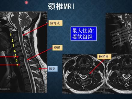 颈椎病到底要拍多少片子它们真有用么第三集颈椎核磁