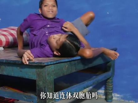 连体双胞胎是如何形成的?他们分离后又该如何生存?#连体双胞胎 #豪斯医生 #抖音精选 #科普