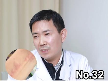 身体一热就发作的胆碱能性荨麻疹,除了药物还需要......#健康守护计划 #医学科普 #胆碱能性荨麻疹