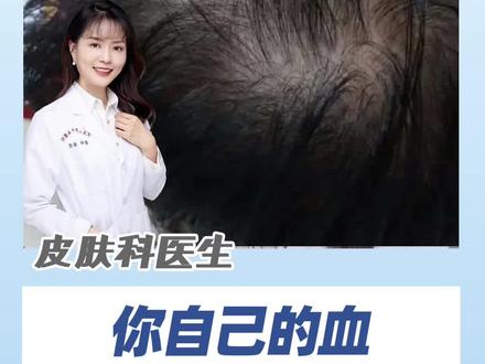 用自己的血还能治脱发?#脱发 #秃头 #健康科普 #生发 #涨知识