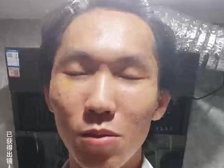 adm填充痘坑七天拆线反馈~ 所有内容均来自真实反馈,已获得顾客肖像使用权,搬运抄袭必究!!! #adm填充痘坑 #皮下分离 #痘坑怎么办 #真实反馈 #内容仅供参考
