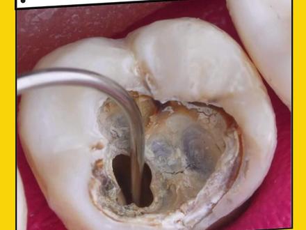 带你沉浸式体验根管治疗 #医学科普 #牙齿矫正 #根管治疗