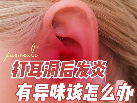 打耳洞后发炎有异味怎么办?#耳洞发炎 #打耳钉 #皮肤科普 #医学科普