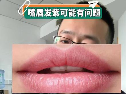 看嘴巴识问题 #紫绀 #嘴巴#@海安市人民医院 @逐梦人