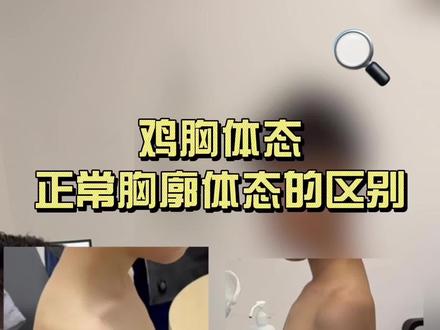 鸡胸体态和正常胸壁体态的区别 #健康科普破圈计划 #抖出健康知识宝藏 #鸡胸 #漏斗胸 #肋骨外翻