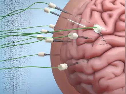 立体定向脑电图 #脑电图 #癫痫灶定位 #SEEG