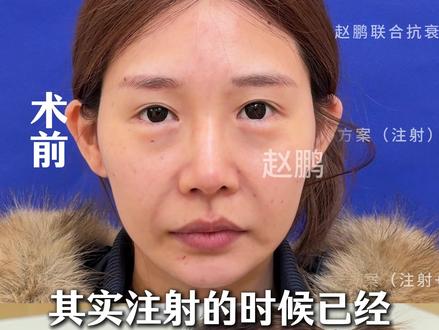 来上海花66000做2.0联合抗衰去妈味,挑战自己的软肋 个人效果差异,出镜人已签署相关肖像授权,此视频不宣导任何风险医疗项目!出镜人已满25周岁!#面部提升三件套#法令纹怎么消除#面部提升#抗衰老#变美