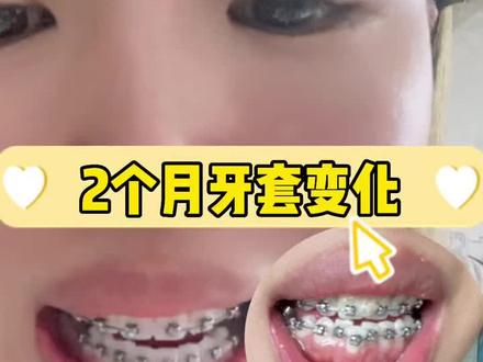 戴牙套两个月,下排牙齿究竟发生什么变化?#记得微笑 #正畸 #牙齿矫正 #十月牙套妹 #骨性嘴凸