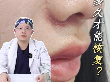 鼻翼缩小多久可以恢复#鼻翼宽大 #鼻翼缩小 #重庆林文韬 #医学科普 #变美