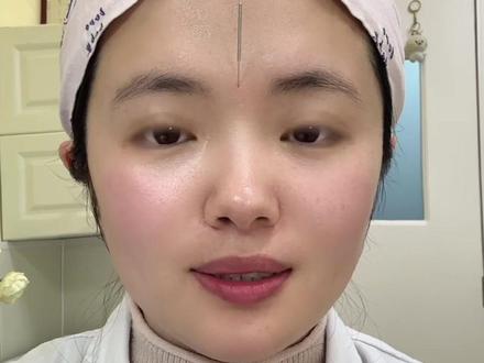 关于【针灸美容】你想知道的,都在这里!#紧致提升#淡斑#法令纹#提亮肤色#医生科普