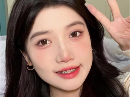 关于牙套的一些小小分享!整牙是我做过最不后悔的决定?吗?#牙套 #牙套日记 #变美逆袭