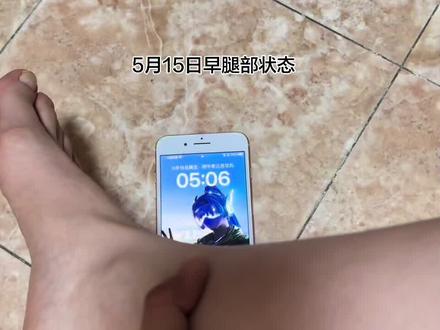 你们要的后续来了! 首先谢谢大家的关心!不只在评论区,还有私信我的兄弟姐妹们,再次感谢大家!
其次,我再说明下我储水的症状不是喝肌酸发生的,我懂得喝肌酸是肌肉储水,不是皮下,但停掉肌酸后,是会皮下储水的!说肾不好不能喝肌酸,这一点我在喝之前了解过,如果肾不好你喝上肌酸尿液是会有变化的,我也观察了没有问题才继续喝直到喝完一瓶300克的肌酸,每天一勺三克的剂量,停掉肌酸后会出现这种情况我也没有想到,毕竟接触健身两年第一次喝,停掉后会有什么反应是我无法预知的,我发视频的初衷也是想会不会有人和我一样预料不到这样的情况发生,起码心里有数,有人和我一样,她是第几天消肿的,如果这么多天还不消,我再去考虑怎么办,以免焦虑!那些说自己喝了几年肌酸都没这样的,人还有吃鸡蛋喝牛奶过敏的呢,每个人个体差异不同,也许我就是那个特例吧!所以到底和肌酸有没有关系呢?
最后说一下,“好言难劝该死的鬼”这句话好像并不是好言,上来就说你这是尿毒症吧的人,你的嘴好像也得病了!#医院检查报告单