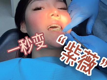 黑三角真的是很烦啊,唯有人民币能填🦍#牙龈萎缩 #牙套 #牙套妹 #牙齿矫正