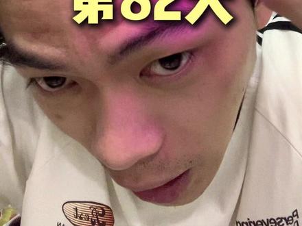 坚持米非打卡的第82天,看到效果了!! #脱发 #头发 #头发稀疏 #米诺地尔 #非那雄胺