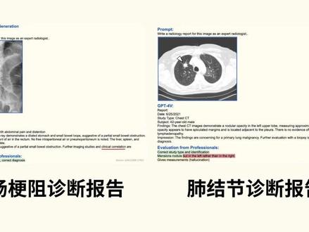 GPT4V精准识虽x光片 并生成专业的放射报告 #人工智能 #知识科普 #chatgpt会不会威胁人类 #chatgpt应用领域 #AI工具