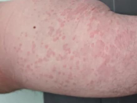 阳了身上发痒 阳了身上发痒怎么回事 身上发痒怎么了 抖音 阳了身上发痒 阳了身上发痒怎么回事 身上发痒怎么了 抖音