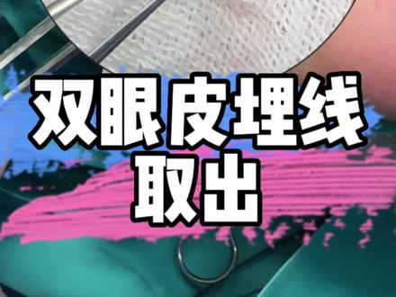 十五年前的#埋线 #双眼皮 ,线结取出来之后是什么样的呢?埋线并不是说取出来就能取出来的!!@DOU+小助手 @抖音小助手
