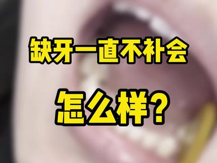 缺了一颗牙一直不补会发生什么呢#补牙#牙齿矫正 #牙齿健康