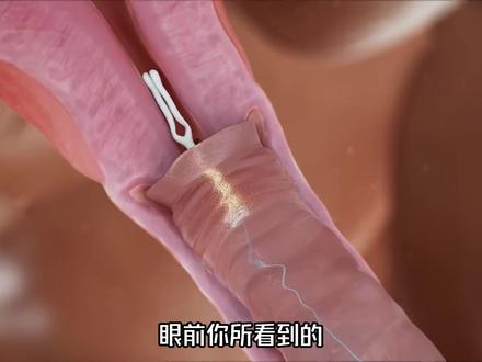 上环的全过程 上环的全过程 #涨知识 #节育环 #女性必看