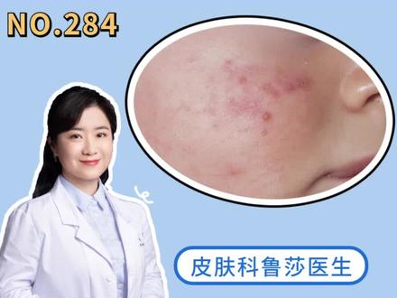 宝宝脸上长#痘痘 是怎么回事?#婴儿痤疮 别忽视了 #医学科普 #皮肤 #怀孕