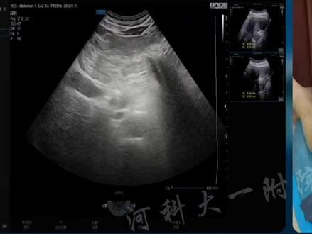 不了小觑的脂肪胰 #医学科普 #超声影像 #每天学习一点点 #不可小觑的脂肪胰 脂肪胰(Pancreatic
lipase)/胰腺脂肪浸润 (Fatty infiltration of pancreas)/胰腺脂肪沉积(Pancreatic fat deposition) 脂肪胰在普通人群中发病率为16~35%,与种族、年龄、性别有关。其后天病因包括肥胖、代谢综合征、饮酒、非酒精性脂肪肝、性激素水平、低出生体重等。先天因素:囊性纤维化、Shwachman-Diamond 综合征(又称中性粒细胞减少伴胰腺功能不全、舒-戴综合征、舒瓦克曼综合征、Burke综合征,是以儿童胰腺外分泌功能不全、白细胞计数减少和干骺端发育障碍为特征的遗传病。婴幼儿多见)、Johanson-Blizzard 综合征(又称鼻翼发育不良,甲状腺功能减退,胰源性胃液缺乏和先天性耳聋综合征)和杂合羧基酯脂肪酶突变,使胰腺腺泡组织被广泛的脂肪代替导致胰腺外分泌功能受损。 导致发生脂肪胰的病理机制主要有两种:与之相关的大量脂肪异位沉积所产生的脂肪浸润,和由于胰腺腺泡细胞死亡所致的脂肪替代。 脂肪胰是一种以胰腺脂肪浸润或胰腺细胞脂肪变性为特征的疾病,也可以称之为胰腺脂肪变性或非酒精性脂肪胰(通常指可逆性胰腺脂肪堆积,与肥胖相关而无显著酒精摄入的脂肪堆积)。 胰腺脂肪浸润声像图诊断标准:胰腺体积正常或者增大,形态饱满,边缘模糊,内部回声弥漫性回声细密、明亮,回声强度接近、≥肠系膜上动脉周围脂肪组织。 胰腺脂肪浸润被细分为四个级: 1级:正常胰腺(非胰腺浸润脂肪),胰腺回声与肾脏实质回声相似。 2级:轻胰腺脂肪浸润,胰腺回声高于肾脏回声,但远低于腹膜后脂肪回声。 3级:中度胰腺脂肪浸润,胰腺回声高于肾脏回声,但略低于腹膜后脂肪回声。 4级:重度胰腺脂肪浸润,胰腺回声与腹膜后脂肪回声相似。